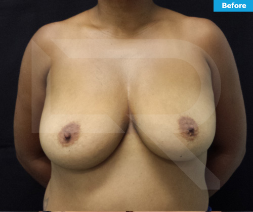 Breast Lift Surgery in Dominican Republic